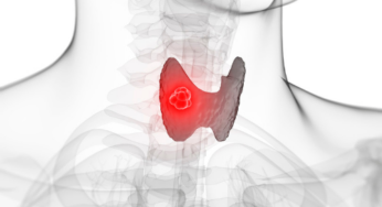 The Missing Link Between Thyroid Issues and MCAS