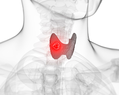 The Missing Link Between Thyroid Issues and MCAS