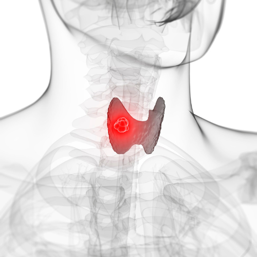 The Missing Link Between Thyroid Issues and MCAS