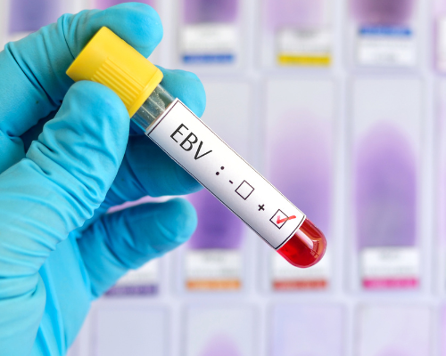 The Connection Between EBV and MCAS