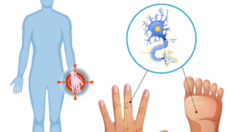 Neuropathy in People with MCAS