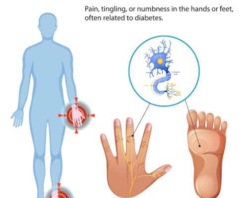 Neuropathy in People with MCAS