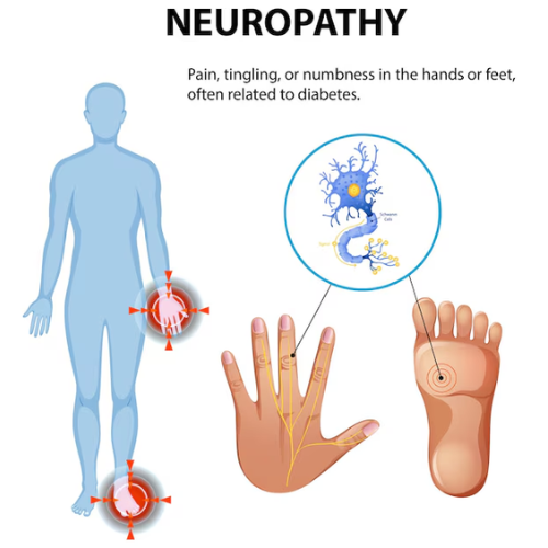 Neuropathy in People with MCAS